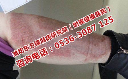 天橋治銀屑病多少錢