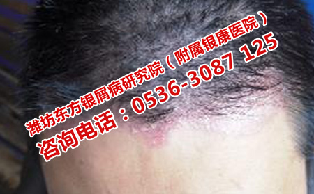 槐蔭治療頭部牛皮癬