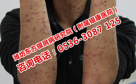 長清哪里看男性牛皮癬理想
