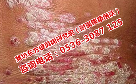 長清理想的牛皮癬醫院