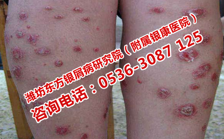 治療銀屑病什么方法理想