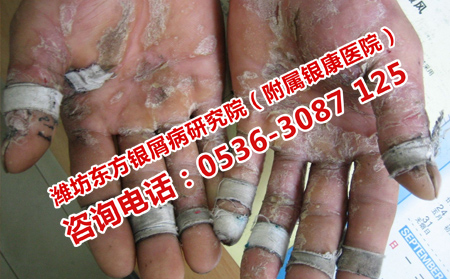 濟南銀屑病研究院怎樣