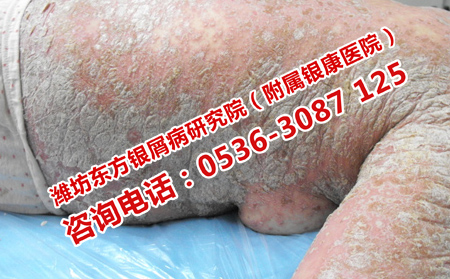 濟(jì)南女性牛皮癬專科醫(yī)院