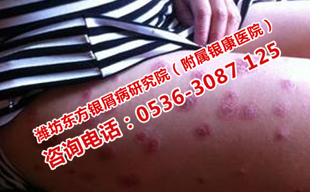 順利治理想牛皮癬