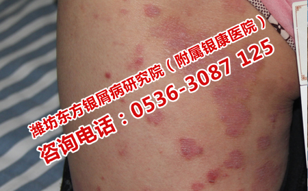 牛皮癬治療不及時的危害