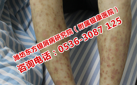 牛皮癬治療費(fèi)用問題