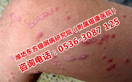牛皮癬治療指南