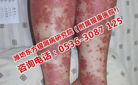 如何治療銀屑病理想的快