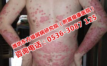 如何護(hù)理牛皮癬呢