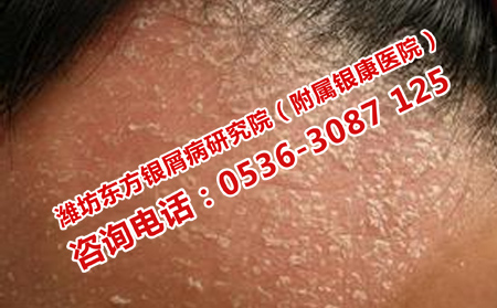 頭部銀屑病的治療