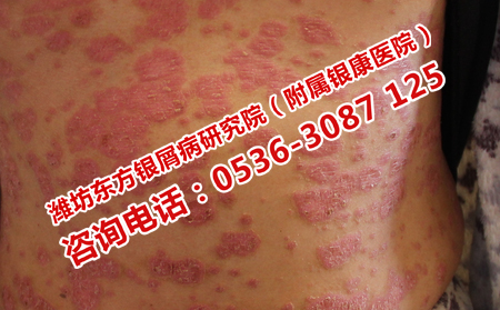 濟(jì)南治銀屑病的價格