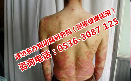 青年銀屑病治療醫院