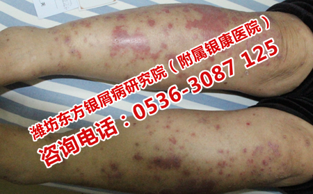 女性牛皮癬如何治療效果理想