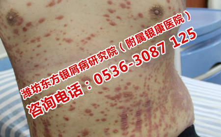 濟南理想的中醫治療銀屑病的醫院