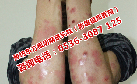 為何銀屑病會復發