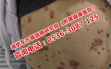 銀屑病的癥狀特征