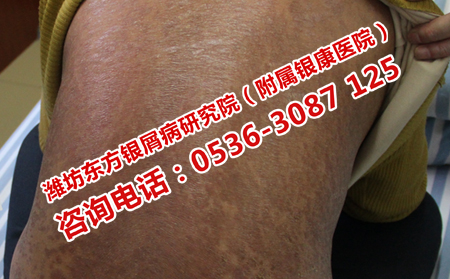 牛皮癬復發了如何治療