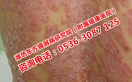 銀屑病患者發燒加重病情