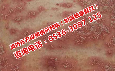 設么樣的醫院治銀屑病有效