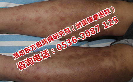 治療銀屑病多少錢呢