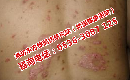濟南銀屑病醫院治療怎么樣