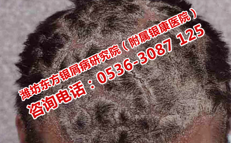 頭部銀屑病的護理細節