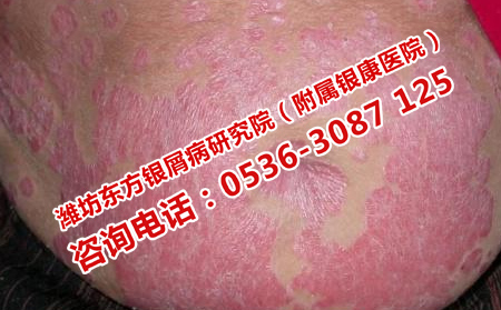 濟南銀屑病醫院治療全身銀屑病