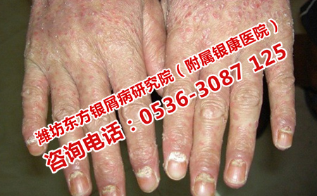 尋常性銀屑病的癥狀