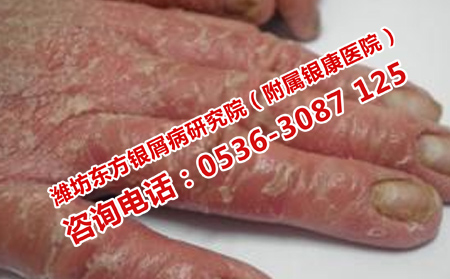 濟南銀屑病醫院電話