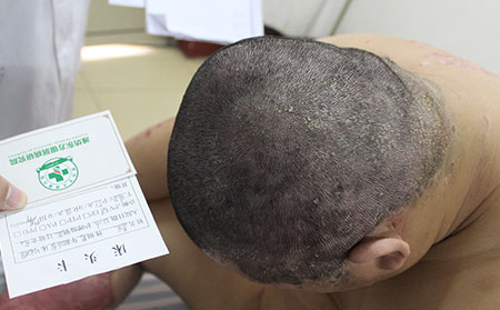 濟南銀屑病患者治療頭部銀屑病