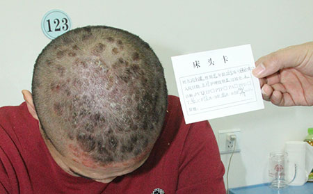 銀屑病如何護理理想