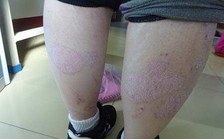 如何預防銀屑病,生活中如何預防銀屑病