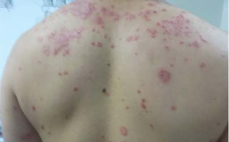 背部牛皮癬癥狀,背部長牛皮癬什么樣