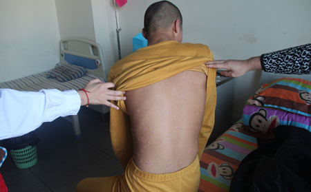 牛皮癬護理方法